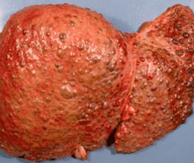 liver-cirrhosis-a3e